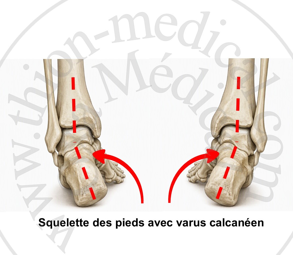 Squelette de pieds varus